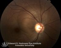 Fundus photograph and fluorescein angiogram of a central serous chorioretinopathy showing a characteristic "smoke-stack" hyperfluorescence
